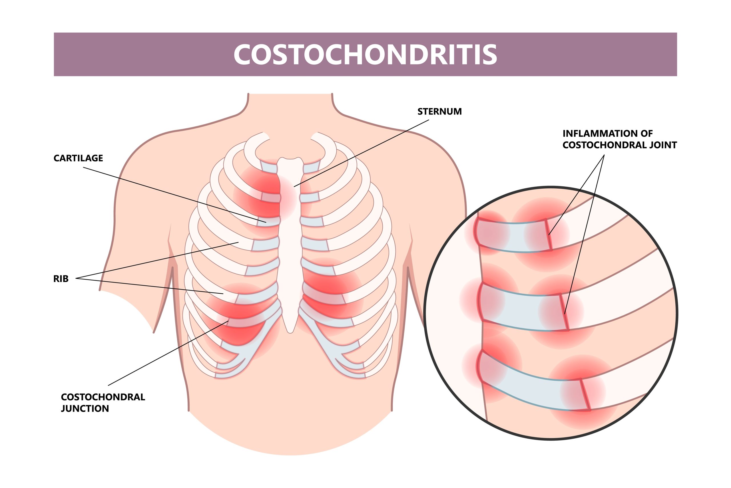 Medical illustration of costochondritis showing inflamed costochondral junctions