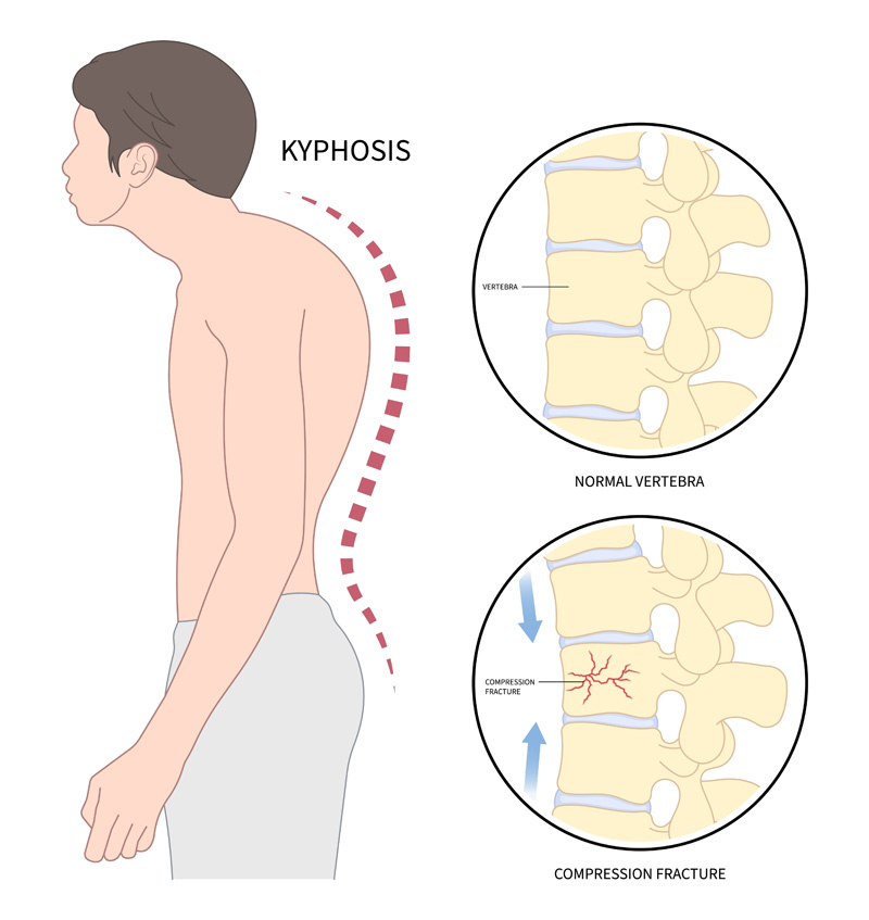 Kyphosis Pain Institute Of Southern Arizona Kyphosis Pain Institute Of Southern Arizona