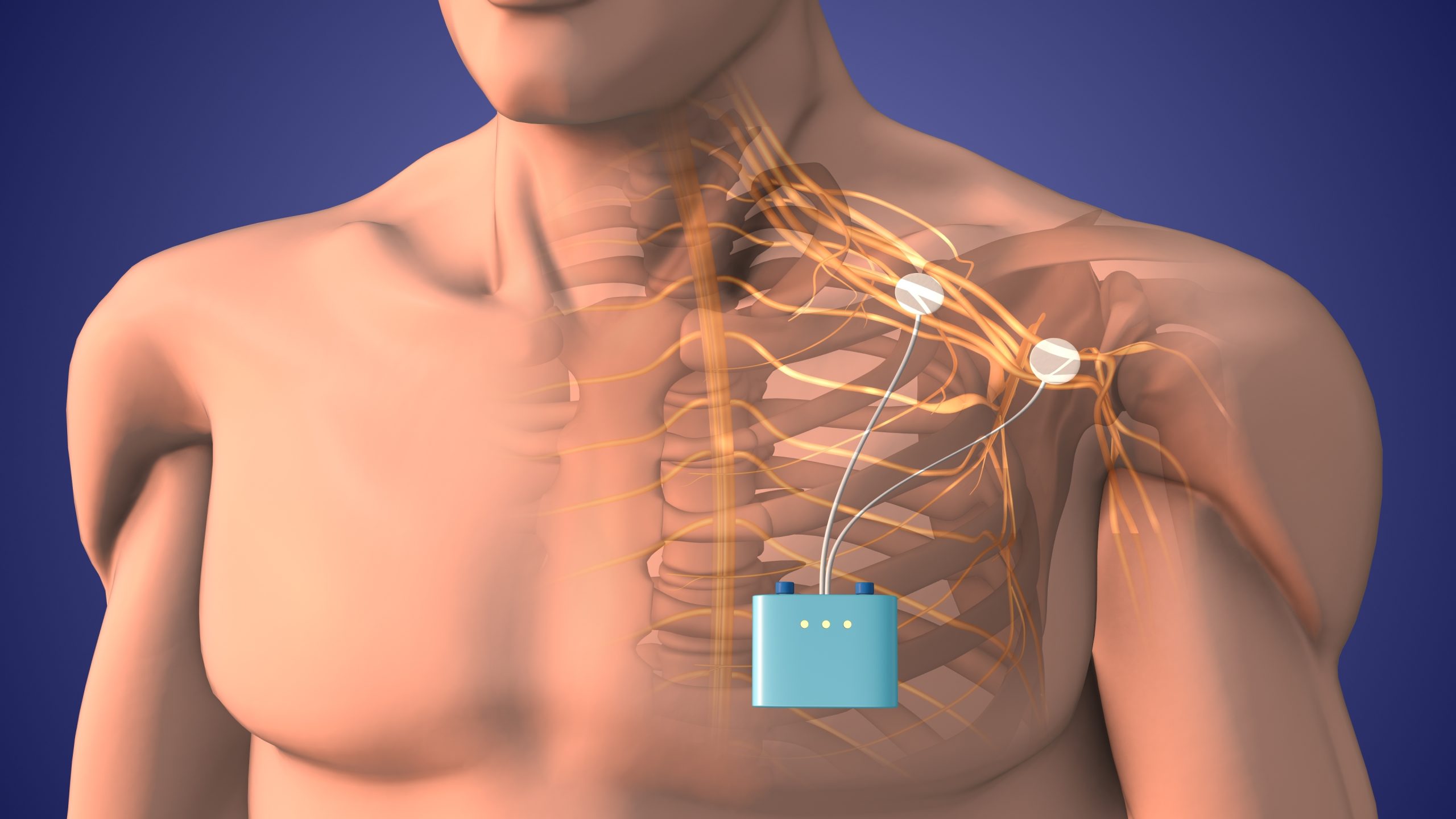 HAS ANYONE ELSE HAD A NEUROSTIMULATOR IMPLANTED FOR PAIN CONTROL visual data 8