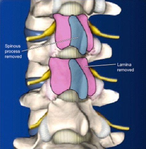 Post-Laminectemy-Syndrome-2